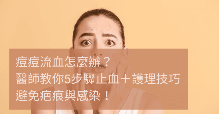 痘痘流血怎麼辦?