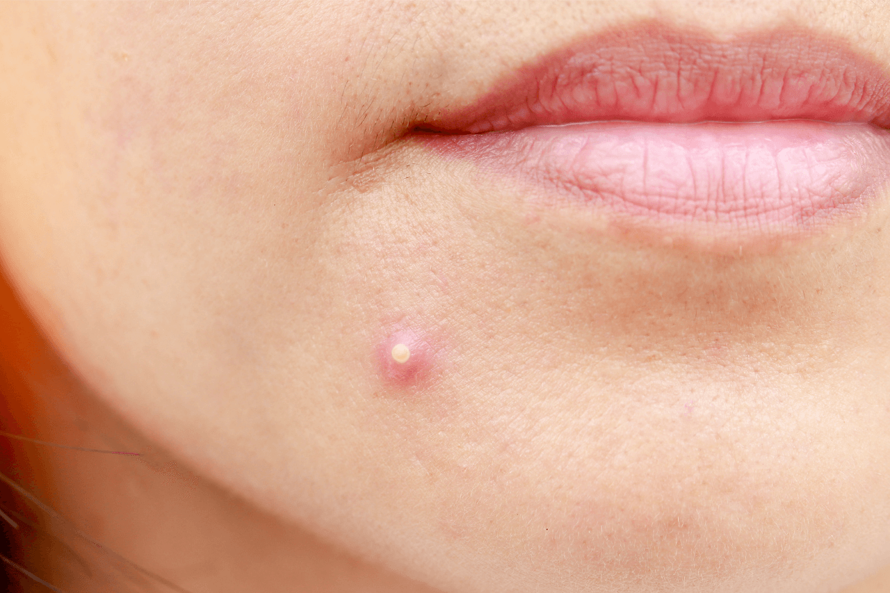 膿皰型青春痘（Pustule Acne）