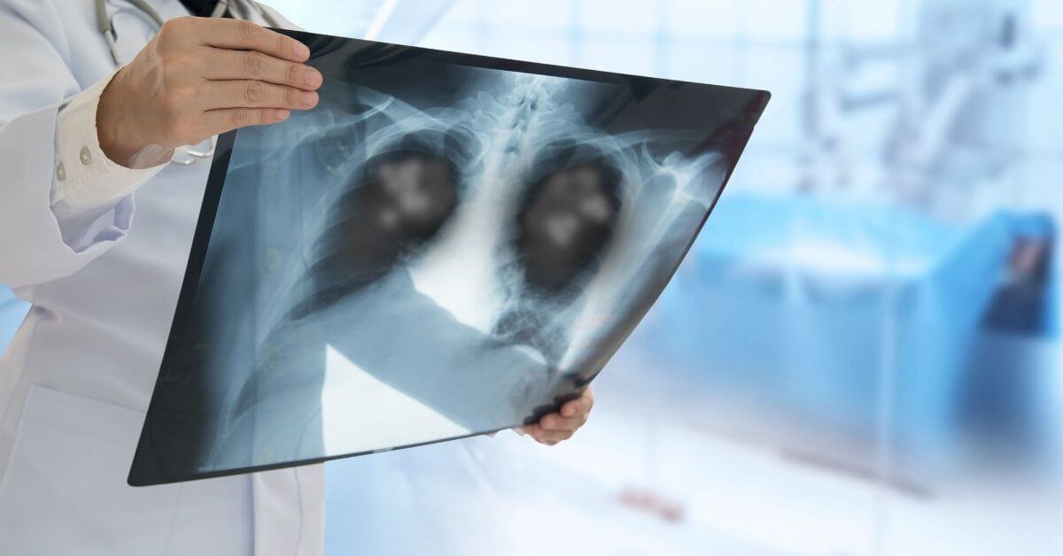 ventilator-associated pneumonia